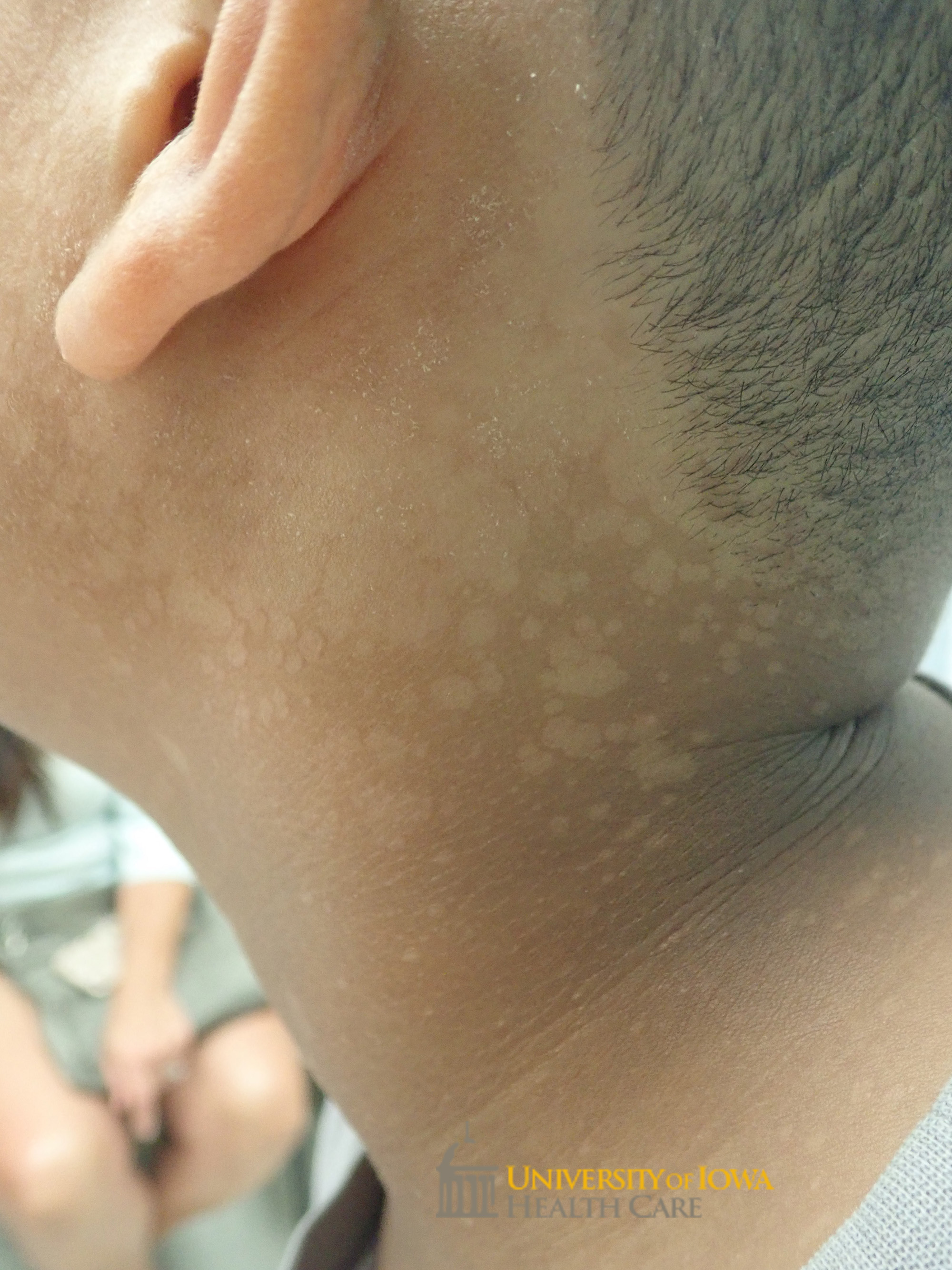 Hypopigmented slightly scaly thin confluent plaques on the posterior neck, ear, and back. (click images for higher resolution).